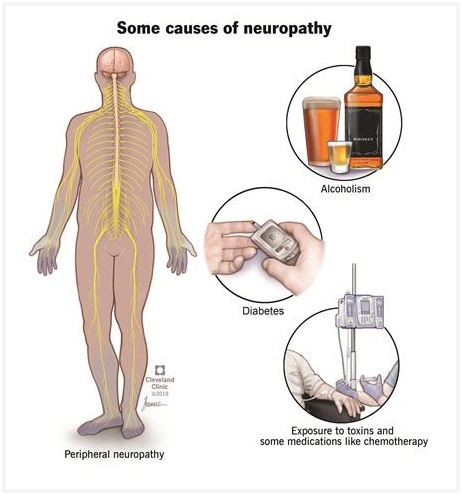 neuropathy