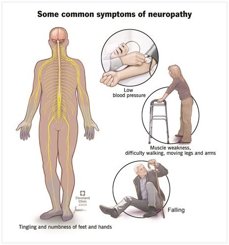 Neuropathy