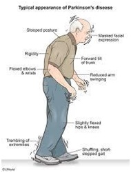 Parkinson's Disease